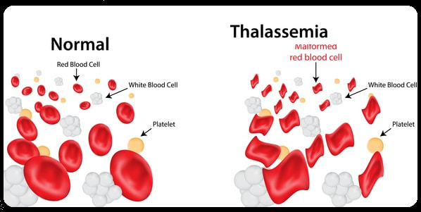 Thalassemia Treatment India